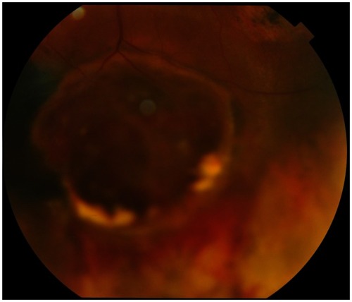 Figure 2 Fundus photograph of the left eye.