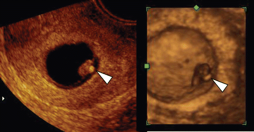 Figure 20.  High echogenic yolk sac (left) 2D ultrasond image of yolk sac (arrowhead) at 9 weeks and 1 day. Small embryo compatible with 7-week-embryo was visible with regular heart beats in the abnormally large amniotic sac. (right) 3D ultrasound image. intrauterine fetal demise was confirmed three days later and villous chromosome was trisomy 15.