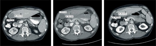 Figure 6 Three consecutive abdominal CT scans of patient #24 carried out in June, August, and December 2014 as shown in three panels from left to right. When treatment initiated in July 2014, the patient had an AFP level of 47,937 ng/mL and 7 malignant lesions including thrombus in the portal vein, which recurred after ablation of 2 original primary tumors (12×11 and 11.1×10.4 cm in right lobe) in February 2014; in August 2014, after 3 weeks on V5, tumor sizes decreased by one third at which point AFP declined to 11,557 ng/mL. After 5 months on daily pill of hepcortespenlisimut-L, 4 out 7 lesions including thrombus cleared with remaining shrinking to under 1 cm at which time point AFP dropped down to 10.5 ng/mL—slightly above of what is considered the normal range between 0 and 8 ng/mL. Scans show planes with location of the largest lesion, which was later recognized as a cyst. By September 2016 all malignant lesions were cleared and AFP declined to 6.8 ng/mL.