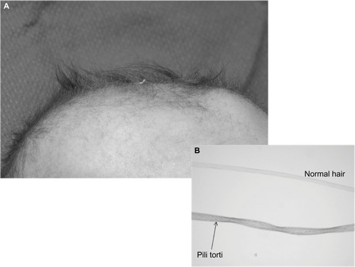Figure 2 MD: (A) scalp shows “kinky hair”, (B) the inset shows “pili torti” and a normal hair strand under a high power microscope.