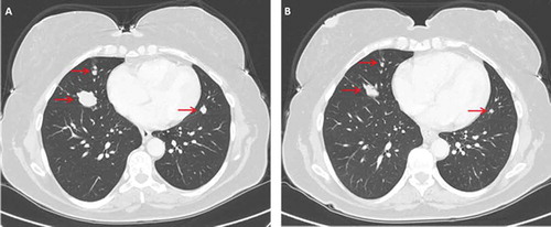 Figure 2. Chest CT of patient 2 before and after initiation of vermurafenib treatment. (A) Arrows indicate presence of lung metastases. (B) The same regions are denoted by arrows on follow up imaging performed 2 month later.