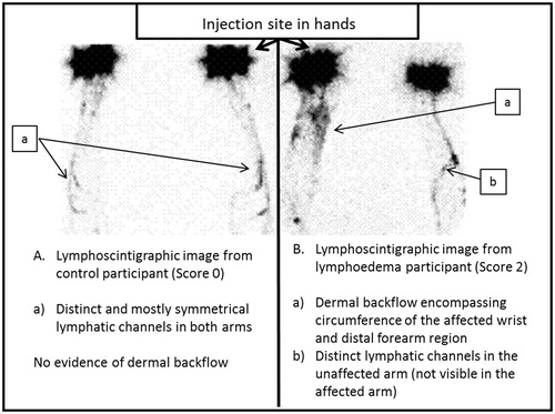 Figure 2. Comparison of lymphoscintigraphic images between a control participant (A) and a participant with LE (B).