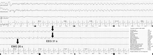 Figure 2 Successful seizure induction following the third stimulation of the eleventh session (right unilateral ultrabrief pulse ECT, Low 0.25, 15%), in which a tonic-clonic motor seizure was first observed.