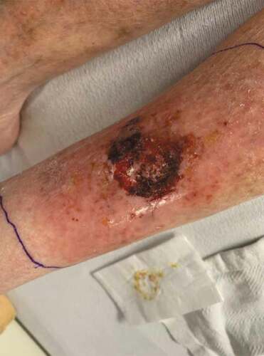 Figure 1. Large ragged painful ulcer with significant surrounding erythema on the left pretibial area