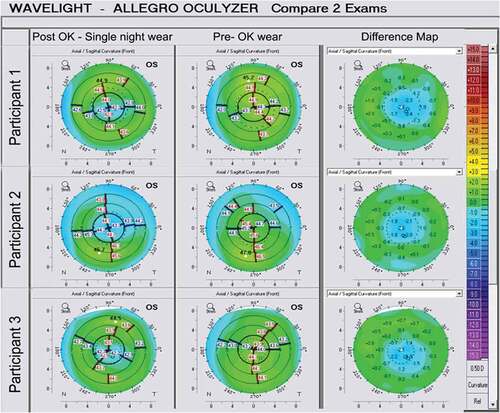 Figure 1. Topography difference map for a participant pre and post overnight Ortho-K lens wear. The panel on the extreme left side is for post overnight Ortho-K lens wear and the panel on the extreme right indicates differences in corneal curvature and thickness pre and post Ortho-K wear.