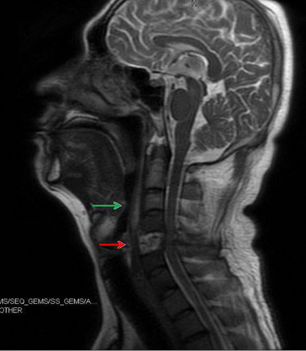Figure 2 Magnetic resonance imaging (MRI) of the cervical vertebra before operation. Green arrow indicates prevertebral abscess, and red arrow indicates bone destruction in the 5th cervical vertebra.