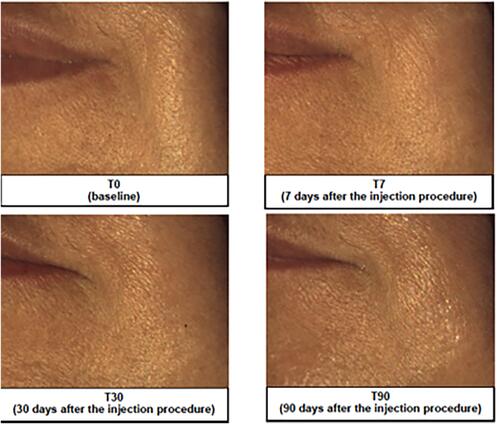 Figure 5 Representative image analysis of improvement marionette lines before treatment (T0), 7 days (T7), 30 days (T30) and 90 days after injection of the brand-new intracutaneous filler. The subject’s midface was evaluated by mean of Vectra H1.