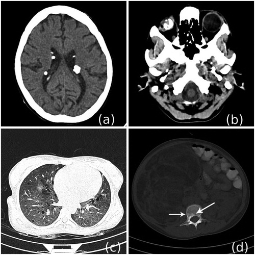 Figure 2. NCCT scan of brain (a) and orbits (b) shows multiple calcified subependymal nodules, and calcified lesion in the right eyeball. Lung window images (c) show multiple thin walled cysts suggestive of lymphangioleiomyomatosis. Bone window image (d) shows few sclerotic lesions (arrow) in vertebra.