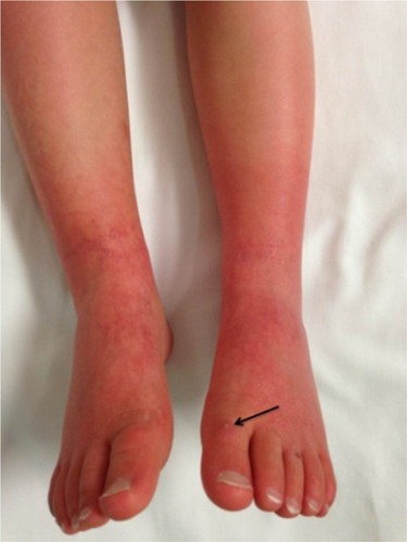Figure 1 Photograph of the lower extremities of patient 1 with primary EM.