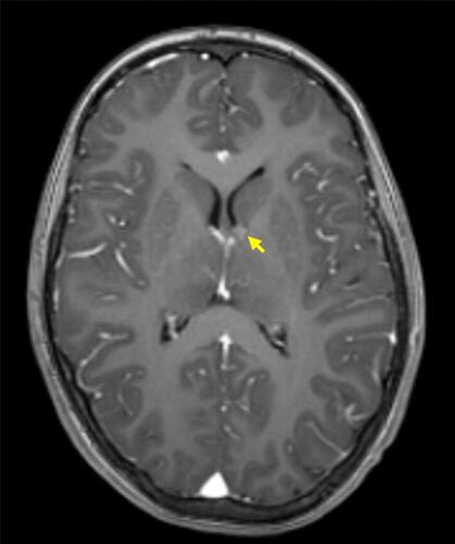 Figure 2 Small SEGA of the left hemisphere, in a child diagnosed with TSC. The image represents a T1-weighted MRI axial section after intravenous gadolinium administration (arrow points to SEGA).