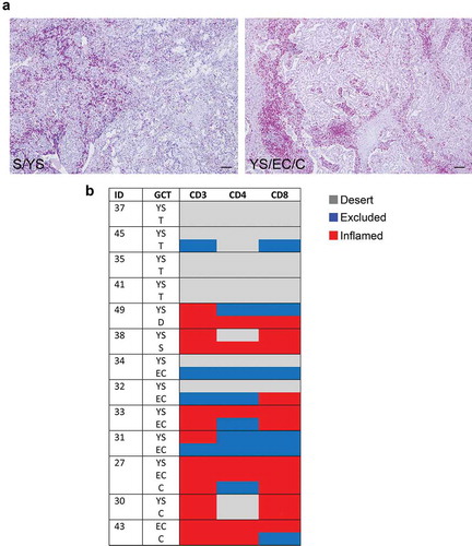 Figure 2. Density of tumor-infiltrating CD3+ T cells in mixed meGCTs a, Representative IHC images for density of CD3+ T cells in primary mixed meGCT samples. CD3+ T cells (red) are differently distributed in mixed meGCT subtypes. Nuclei were counterstained with hematoxylin (blue). Original magnification, x10. Scale bar, 30 µm. b, Distribution of tumor-infiltrating CD3+ T cells in mixed meGCTs. The immune phenotypes are indicated as follows: immune inflamed, immune-excluded, and immune desert in red, blue and gray, respectively. S, seminoma; D, dysgerminoma; YS, yolk sac tumors; T, teratoma; EC, embryonal carcinoma; C, choriocarcinoma.