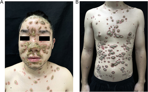 Figure 1 Clinical appearance of the patient before treatment. His head, face (A), torso, and limbs (B) can be seen as extensive, well-defined, round patches of erythema covered with thick, greasy yellow scales, similar to oyster shells.