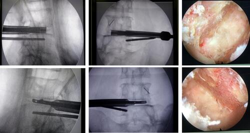 Figure 4 Bone graft bed preparation. The width adjustable reamer and endplate curette are used to prepare the cartilage endplate to adequately expose the bony endplate. Finally, Intervertebral space is fully prepared and the appearance of exudation from bone endplate is good, the bony endplate is fully exposed.
