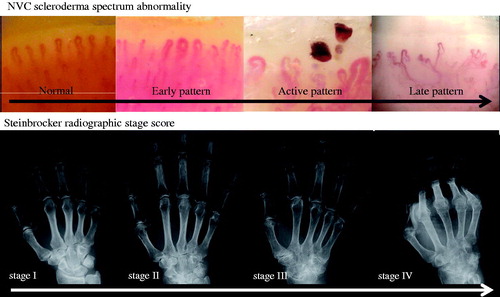 Figure 7. Comparison between NVC scleroderma spectrum abnormality and Steinbrocker radiographic stage score.