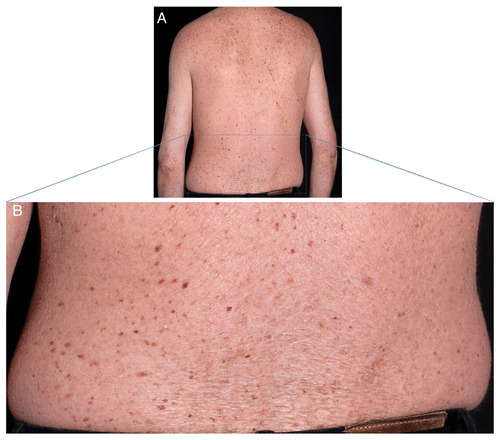 Figure 5. Lentiginous and dry skin. (A) Lentiginous back of TTD238DOD. (B) Close-up of (A) with ichthyosiform skin.