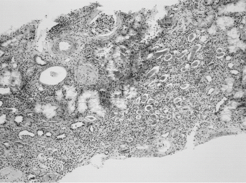 Figure 1. Renal biopsy specimen: tubulo-interstitial nephritis. Tubulointerstitial involvement with sclerosed majority of glomeruli (two of three). Stained by hematoxylin-eosin; magnification × 200.