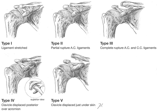 Figure 3 Rockwood classification (courtesy of shoulder and elbow expertise center).