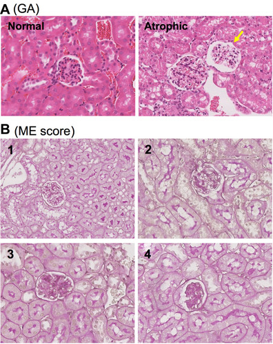 Figure 1 Semi-quantitative scoring system for histological evaluation of MN in mice. (A) Typical images of normal and atrophic glomerulus (pointed by yellow arrow). (B) The scoring of mesangial expansion (ME) from 1 to 4. 1: 0–24% of the area affected with densely stain, normal to minimal; 2: 25–49%, mild; 3: 50–74%, moderate; and 4: >75%, severe.