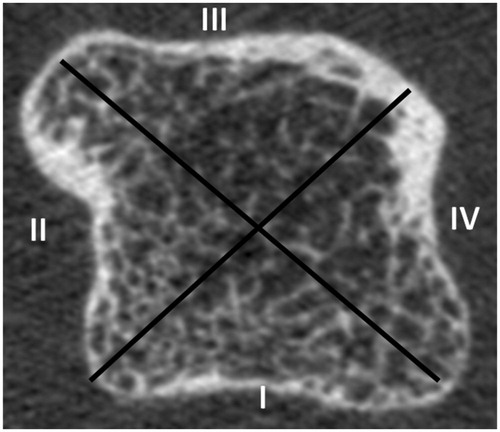 Figure 2. Axial plane of 2nd metacarpal head HR-pQCT scan with the anatomic division in four quadrants: I (palmar), II (ulnar), III (dorsal), IV (radial).