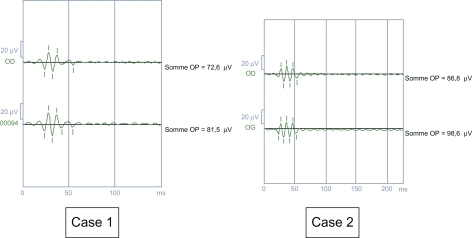 Figure 8 Reduction of oscillatory potentials, the lowest being phot-OP 4.