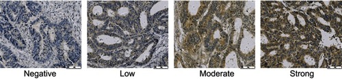 Figure 1 Immunohistochemical staining of CXCL16 expression in CRC.