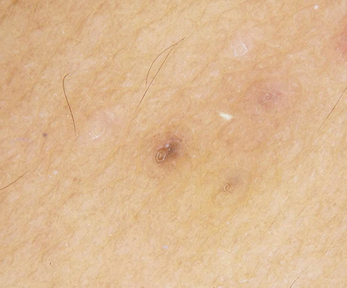 Figure 3 Dermoscopic features: brownish, slightly elevated border follicular papules with central keratin plugs (original magnification x20).