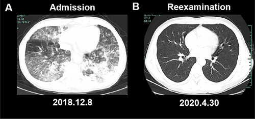 Figure 4 Chest CT image. (A) The chest CT in our hospital showed multiple lung lesions with exudation and fluid in both pleural cavities. (B) The reexamination of chest CT after discharge showed a marked improvement compared to the last examination; ground-glass attenuation was absorbed for both lungs.