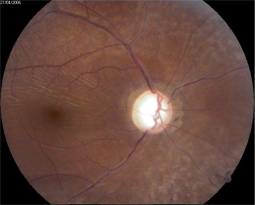 Figure 4 Retina and optic disc in OD.