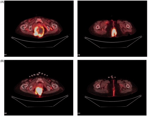 Figure 1. (A) PET-CT scan before hyperthermia (March 2017). The image revealed huge presacral mass with invasion to the skin over the anal area. (B) PET-CT scan after hyperthermia (August 2017). The image revealed much regression of mass.