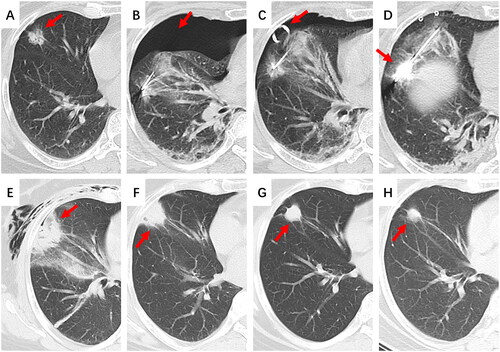 Figure 4. A female, 65-year-old patient with GGN-like lung cancer in the RML underwent MWA. (A) A mixed GGN located in the RML with a diameter of 17 mm. (B) An antenna was inserted into the tumor through the interlobar fissure. A large amount of pneumothorax occurred during the procedure, causing tumor displacement. (C) Continuous negative-pressure chest drainage was performed. (D) After negative-pressure aspiration, the procedure was continued. (E) The lesion was covered by ground-glass opacity, displaying a “fried egg” sign, and the amount of pneumothorax and subcutaneous emphysema did not increase at 72 h after MWA. (F) The lesion gradually involuted at 1 month after MWA. (G) The lesion gradually involuted at 10 months after MWA. (H) The lesion gradually involuted into a fibrous scar at 25 months after MWA.