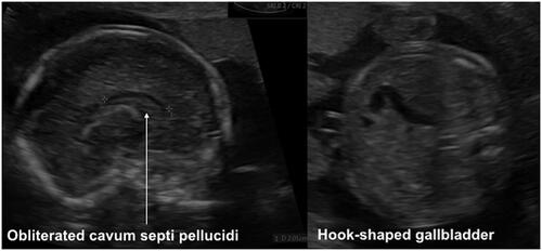 Figure 1. Prenatal ultrasound pictures showing the presence of a sagittal view of the fetal brain showing a normal corpus callosum and obliterated cavum septi pellucidi and a transverse view of the fetal abdomen with a hook-shaped gallbladder.