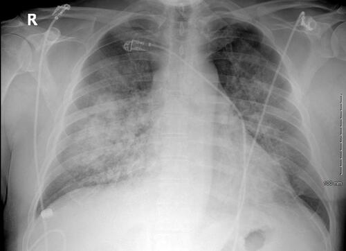Figure 1 Emergency department chest X-ray showing pulmonary edema without cardiomegaly.
