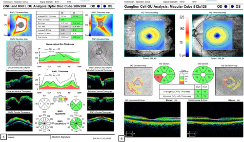 Figure 11 (A) ONH OCT with marked disc edema 360 in all quadrants of the right eye compared to the left eye (B) Ganglion OCT showed no significant defect in both eyes.