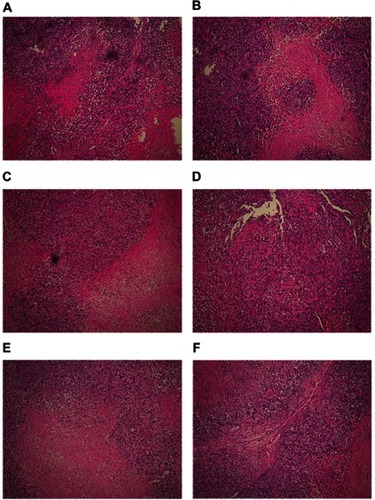 Figure 2 Pathological changes observed in the treatment and control groups (100×). Moderately differentiated squamous cell carcinoma was accompanied by necrosis. Tumors from mice in the miR-145 treatment groups showed areas of apoptotic cells with characteristic cell shrinkage, cytoplasmic condensation, and apoptotic bodies. These effects were more pronounced in the high-dose miR-145 treatment group. (A) Unmanipulated control group, (B) glucose solution control group, (C) transfection reagent control group, (D) non-specific gene sequence control group, (E) miR-145 high-dose (1.0 OD) group, and (F) miR-145 low-dose (0.5 OD) group.