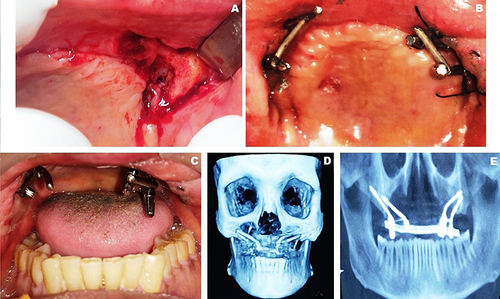 Figure 4 (A) Surgical exposure of zygomatic bone. (B) Implants welded using short solid bars. (C) Impression caps in place. (D) Prosthesis design as seen on CBCT. (E) Orthopantomograph with the framework (closed mouth).