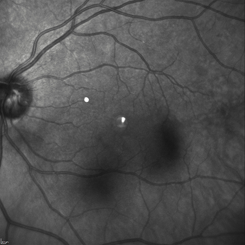 Figure 1 Infrared fundus picture of a symptomatic patient, the obscuration casted by the vitreous opacities can be visualized, the symptomatic patient had higher obscuration and more central location of the opacities.