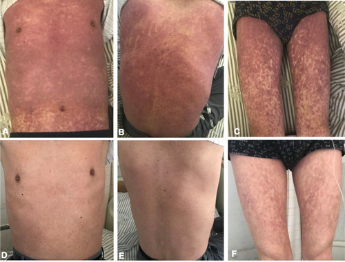 Figure 2 The change of skin rash induced by cladribine in HCL, before (A–C) and after (D–F) rescue. The diffuse, exfoliated, and itchy erythema (throughout the chest, back and limbs) gradually faded after a combination treatment with corticosteroids, immunoglobulin, ebastine, and sodium thiosulfate.