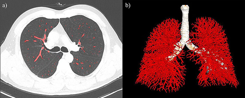 Figure 1 Extraction of pulmonary vessels based on low-dose CT images. (a) showed tracing pulmonary vessels from low-dose chest CT images. (b) showed extraction of pulmonary vessels.