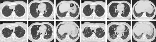 Figure 6 A 44-year-old male smoker with pathologically diagnosed RB-ILD.