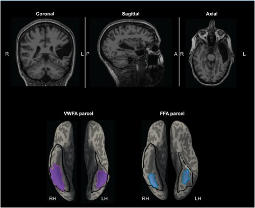 Figure 2. EG’s MRI showing the missing cortex and the parcels for the right and left VWFA and FFA. Top, T1-weighted images in coronal, sagittal, and axial views. Bottom, the VWFA (purple) and FFA (blue) parcels are projected on EG’s reconstructed surface. The parcels served as spatial constraints in defining the fROIs (see Methods), but we also explored the entire VTC for category selectivity (outlined with black solid lines). By design, the parcels are relatively large (to accommodate inter-individual variability in the precise locations of these areas) and therefore can overlap, but the individual fROIs are small and do not overlap. Note that even though part of the anterior lVTC is missing in EG, the stereotypical locations for both the VWFA and FFA are spared.