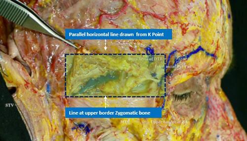 Figure 12 Temporal venous danger zone delineated by the upper margin of the zygomatic bone and a parallel horizontal line running from the K Point, at the junction of temporal crest (TC) and lateral orbital rim.