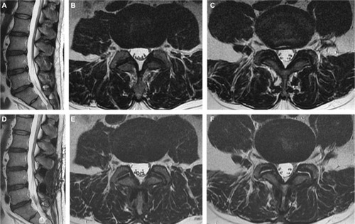 Figure 5 MRI images before and after DIAM implantation.