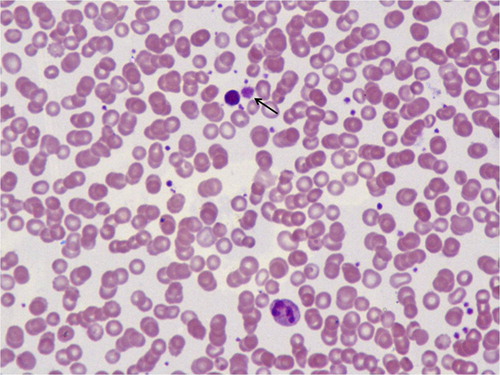 Figure 1. Peripheral smear from a patient with diabetic complication showing occasional giant platelets (arrow) with normocytic normochromic erythrocytes (Giemsa, ×100).