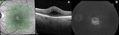Figure 1 Macular edema secondary to intermediate uveitis in a 58-year-old male patient (left eye). (A) OCT. (B) FFA – typical petaloid pattern.Abbreviations: OCT, optical coherence tomography ; FFA, fundus fluorescein angiography.