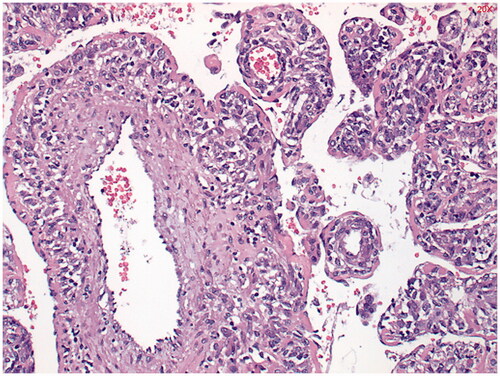 Figure 3. Hematoxylin and eosin (HE) staining shows the perivascular growth of the tumor.