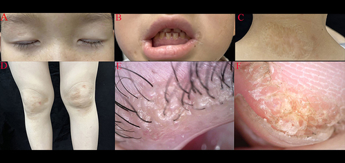 Figure 1 Physical examination revealed beaded papules on the upper eyelid margin (A), disordered arrangement of teeth and gingival hyperplasia (B), diffused atrophic scar on the whole body (C), and brownish-yellow plaques on both knees (D), clustered light yellow oval structureless area on the upper eyelids (dermoscopy) (E), verrucous, keratinized, proliferative lesions around the nails (F).