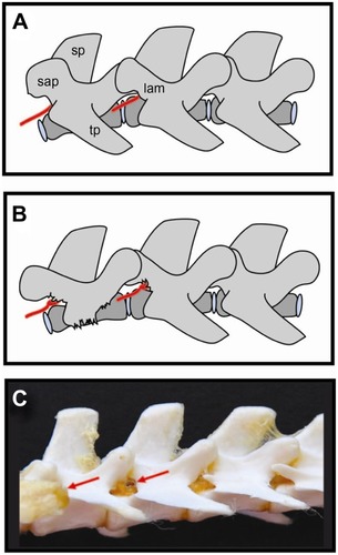 Figure 2 Schematic drawings (A and B) and photo (C) of rat spine depicting position of dorsal root ganglia and surgical approach used for DRG injection.Citation36 Reliably precise injection can be performed using minimal laminectomy, while blind needle-insertion approach requires a lot of skill and experience. The dorsal root ganglion is covered by laminar bone. (B) Removal of laminar bone superior to the foramen and the L4 accessory process reveals the distal dorsal root ganglion, recognized by its broader diameter.