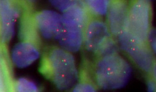 Figure 3 BCL-6 gene rearrangement in PGI-DLBCL cells (ileocecal) (400×). In normal cell hybridized with the BCL-6 probe, the expected signal pattern is two red and green fusion signals (2F). Nucleus with a translocation breakpoint involving the BCL-6 gene showing a one red, one green, and one fusion (1R1G1F) pattern.