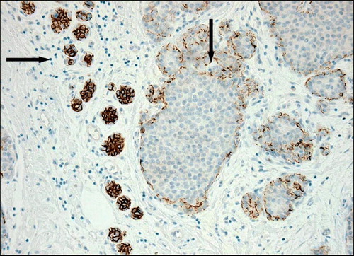 Figure 3.  LCIS presented with loss of E-cadherin (↓v). Normal ductal epithelium with positive staining of E-cadherin (→) by IHC.