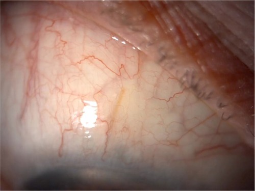 Figure 2 Xen45 stent (AqueSys Inc., Aliso Viejo, CA, USA) visible in the conjunctival space in a patient with iridocorneal endothelial syndrome.